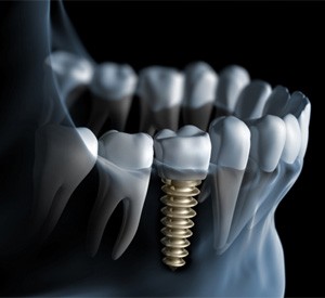 -ray illustration of a dental implant in Richardson