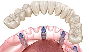 Digital illustration of all-on-4 dental implants