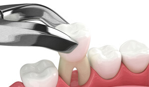 illustration of tooth extraction