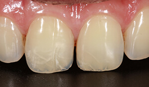 Craze Lines on Teeth: Are My Teeth Cracked?