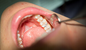agape mouth being examined with dental mirror