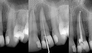 Scan of a root canal therapy procedure
