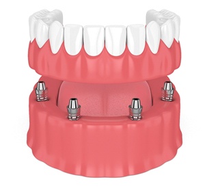 implant-supported denture