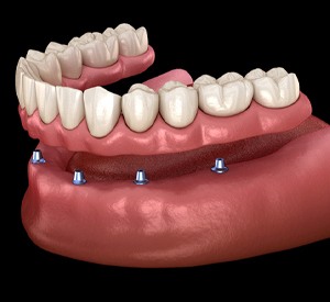 implant-retained denture