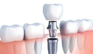 -: Digital illustration of a dental implant slightly separated 