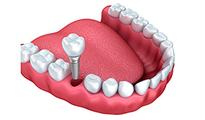 cartoon depiction of dental implants