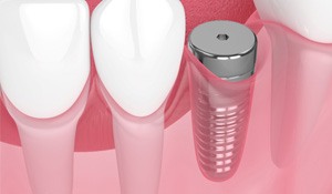 Digital illustration of a dental implant