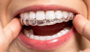 Woman adjusting her clear braces