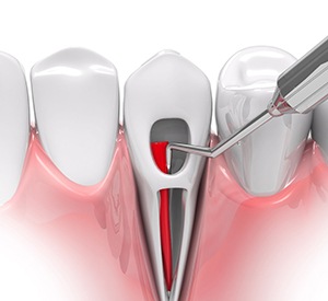 illustration of root canal in Richardson  