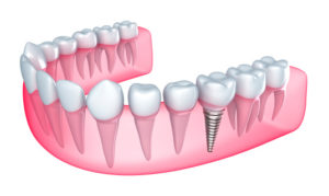 illustration of dental implant