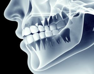 x-ray image of jaw and teeth