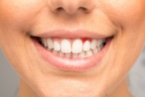 woman showing red spot on gums