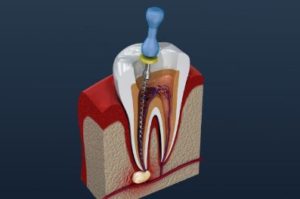 Illustration of a root canal procedure