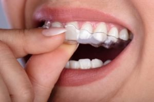 person inserting Invisalign in Richardson