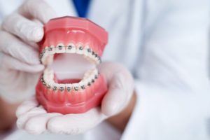 dentist holding diagram of traditional braces