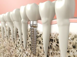 Dental implant placed using a cone beam scanner in Richardson.