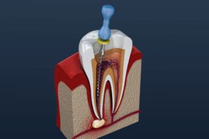 Model of root canal procedure