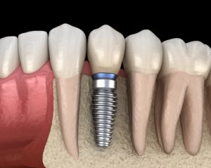 Digital model of dental implant