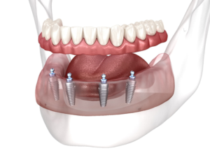 a graphic render illustrating All-on-4 dental implants