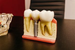 Model of a dental implant replacing a lost tooth
