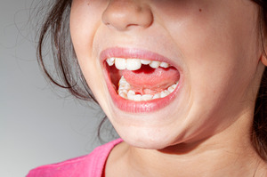Little girl in need of early orthodontic treatment