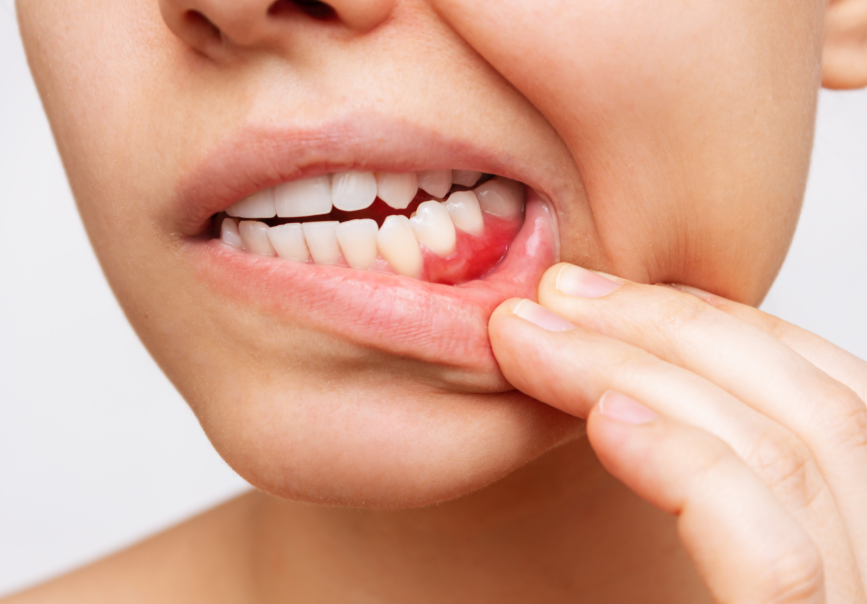 Close up of a person pulling down their lower lip to reveal a swollen and reddened area of gum tissue around the lower teeth. The irritated gums show visible inflammation near the gumline.